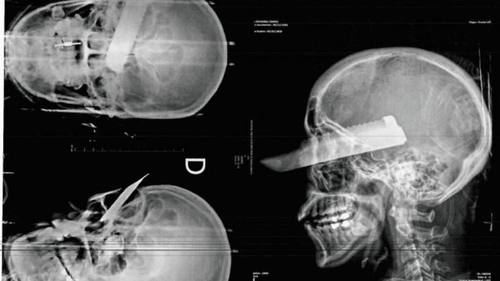 Radiografia mostra ferimento gravíssimo na cabeça de mulher e companheiro acaba preso horas depois no interior de São Carlos.