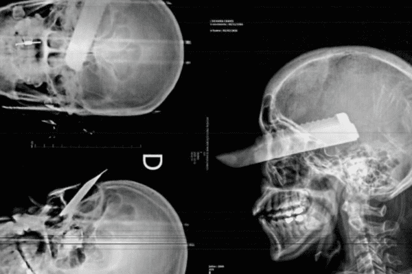 Radiografia mostra ferimento gravíssimo na cabeça de mulher e companheiro acaba preso horas depois no interior de São Carlos.