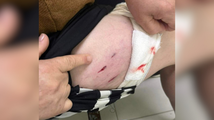 Lesões na coxa de mulher atacada por cães de rua em Xanxerê